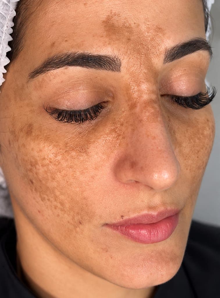 Manchas e melasma: antes